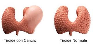 Tiroide con cancro